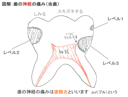 歯の痛み 図解